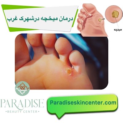 درمان میخچه در شهرک غرب