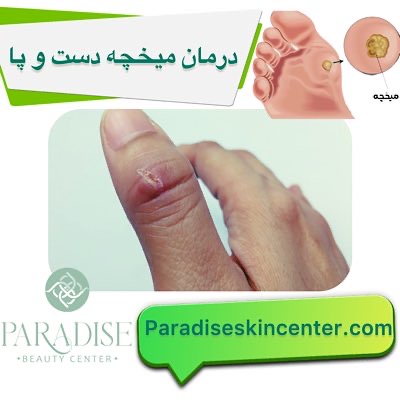 درمان میخچه پا و دست