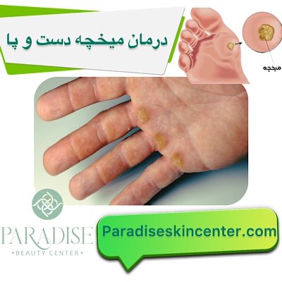 درمان میخچه پا و دست