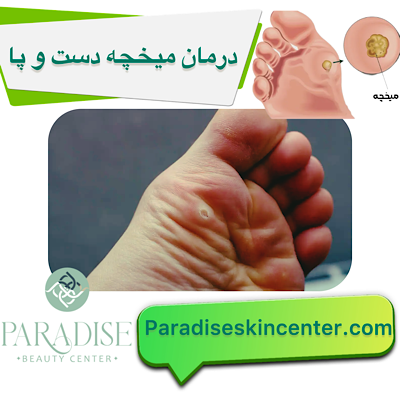 درمان میخچه پا و دست