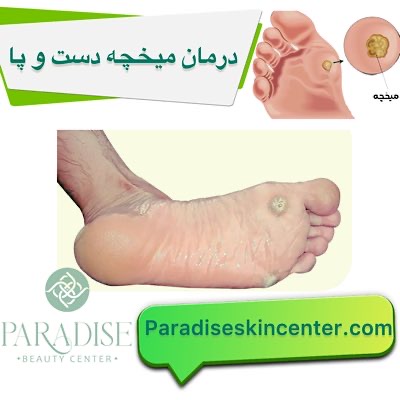 درمان میخچه پا و دست