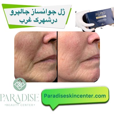 ژل جوانساز جالپرو در شهرک غرب