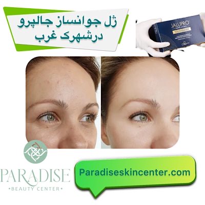 ژل جوانساز جالپرو در شهرک غرب