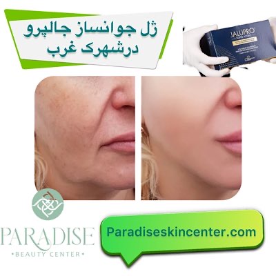ژل جوانساز جالپرو در شهرک غرب