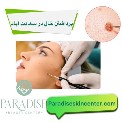 برداشتن خال در سعادتآباد