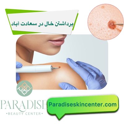 برداشتن خال در سعادتآباد