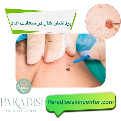 برداشتن خال در سعادتآباد