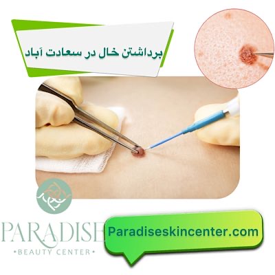 برداشتن خال در سعادتآباد