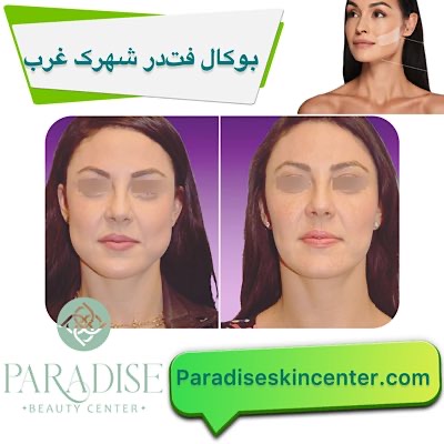 بوکال فت