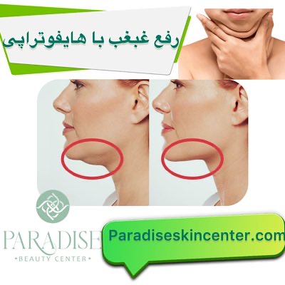 رفع غبغب با هایفوتراپی