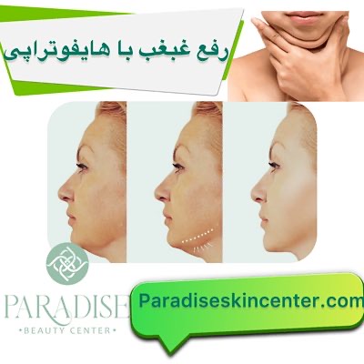 رفع غبغب با هایفوتراپی