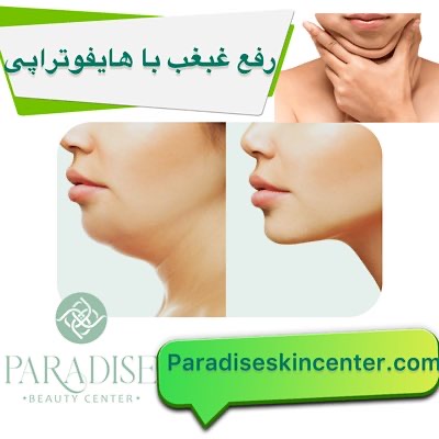 رفع غبغب با هایفوتراپی
