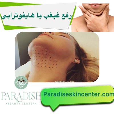 رفع غبغب با هایفوتراپی