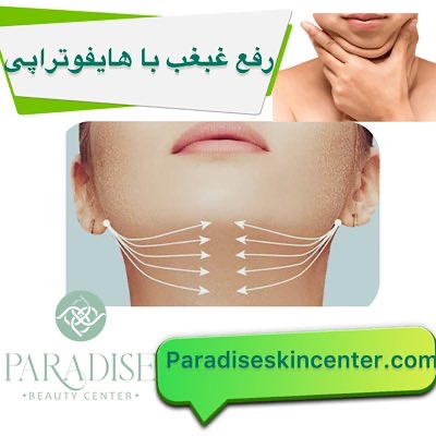 رفع غبغب با هایفوتراپی
