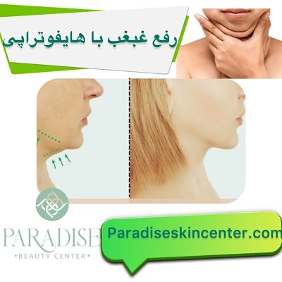 رفع غبغب با هایفوتراپی