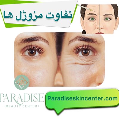 تفاوت مزوژلها