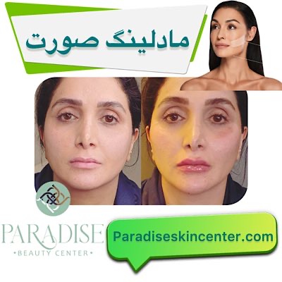 مادلینگ صورت