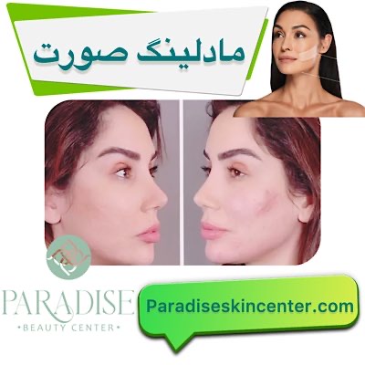 مادلینگ صورت