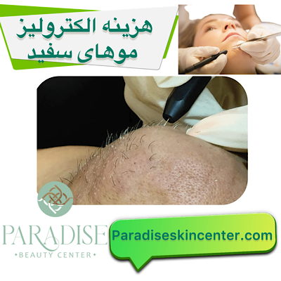 هزینه الکترولیز موهای سفید