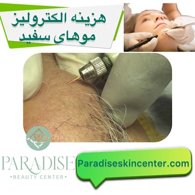 هزینه الکترولیز موهای سفید