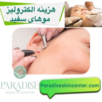 هزینه الکترولیز موهای سفید
