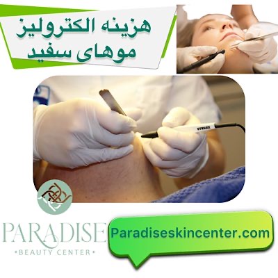 هزینه الکترولیز موهای سفید