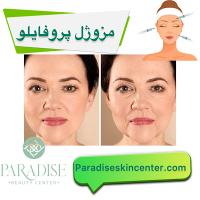 مزوژل پروفایلو