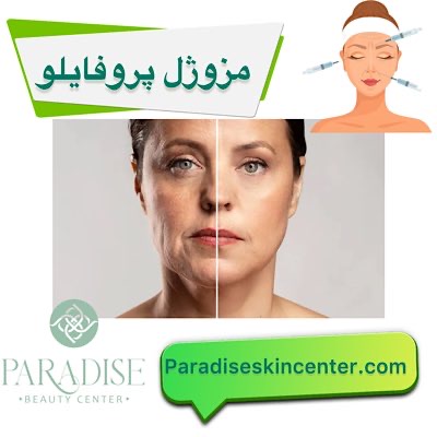 مزوژل پروفایلو
