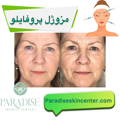 مزوژل پروفایلو