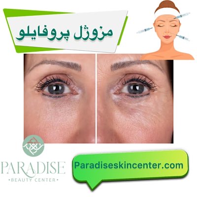 مزوژل پروفایلو