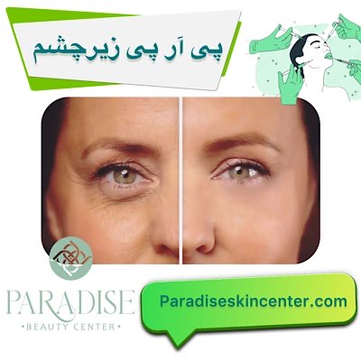  پی آر پی زیر چشم