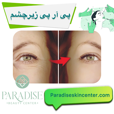  پی آر پی زیر چشم