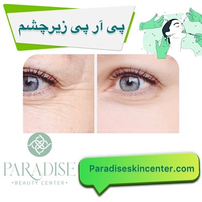  پی آر پی زیر چشم