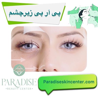  پی آر پی زیر چشم