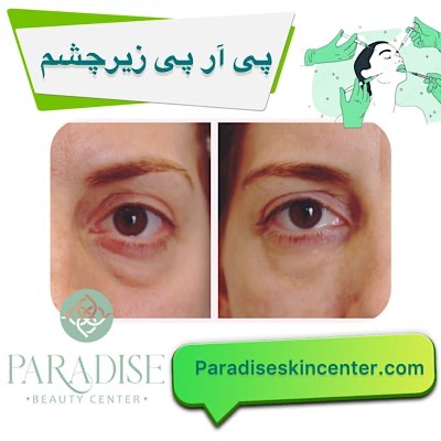  پی آر پی زیر چشم