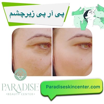  پی آر پی زیر چشم