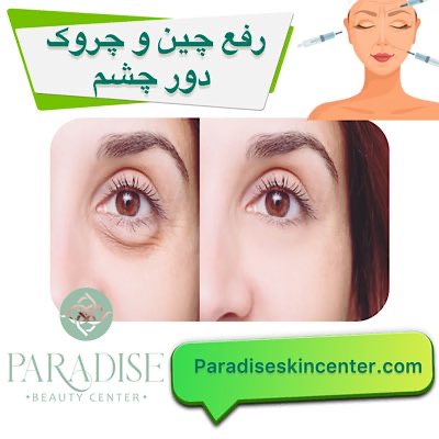 رفع چین و چروک دور چشم