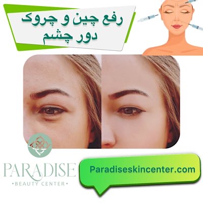 رفع چین و چروک دور چشم