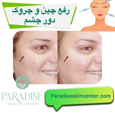 رفع چین و چروک دور چشم
