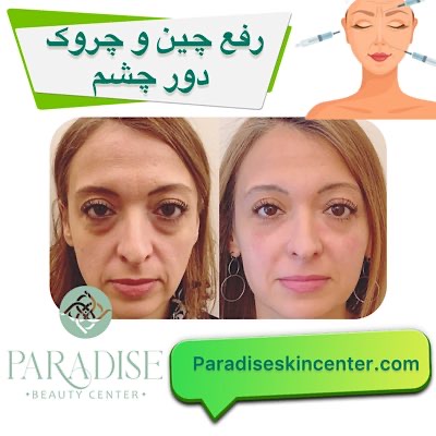 رفع چین و چروک دور چشم