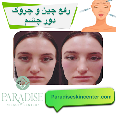 رفع چین و چروک دور چشم