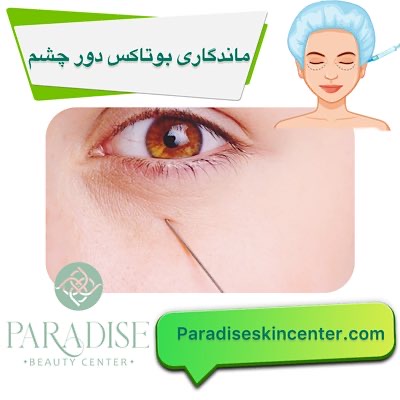 ماندگاری بوتاکس دور چشم