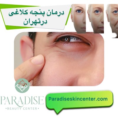 درمان پنجه کلاغی در تهران