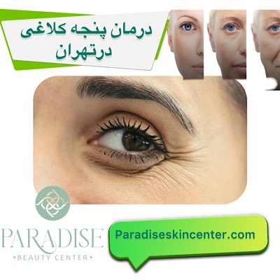درمان پنجه کلاغی در تهران