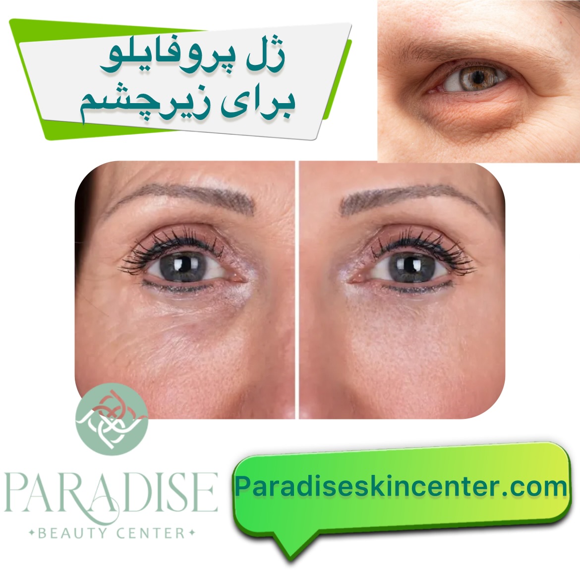 ژل پروفایلو برای زیر چشم