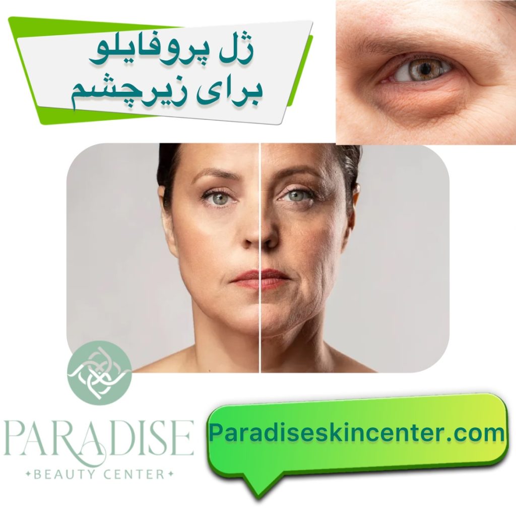 ژل پروفایلو برای زیر چشم