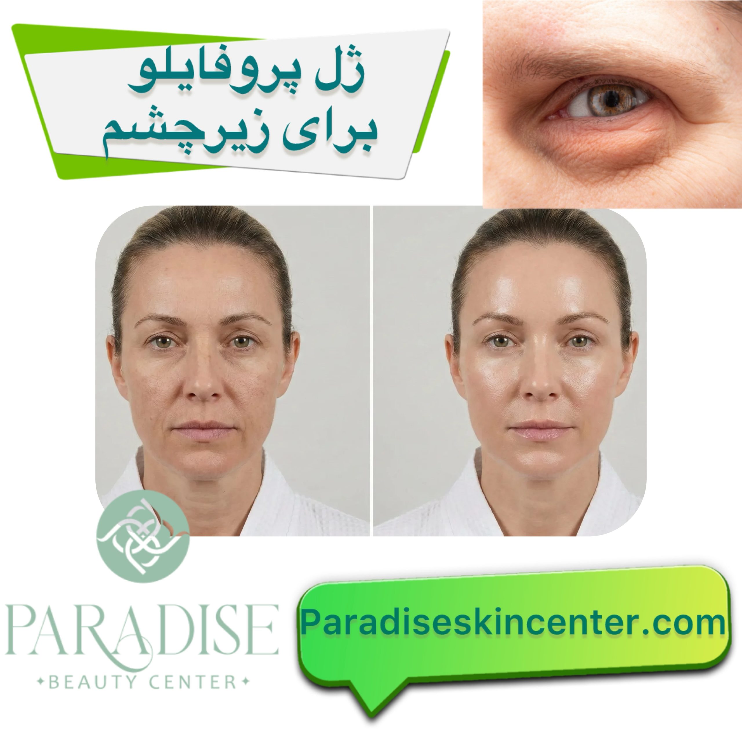 ژل پروفایلو برای زیر چشم