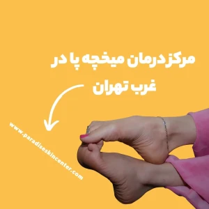 مرکز درمان میخچه پا در غرب تهران