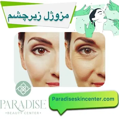 مزوژل زیرچشم