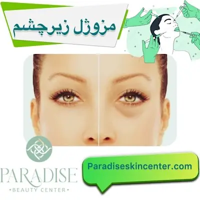 مزوژل زیرچشم